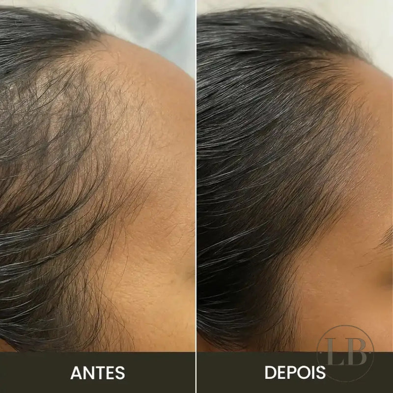 Kit Anti-Queda | Escova Therabrush & Óleo de Alecrim